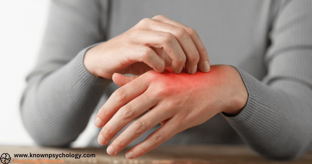 Treatment for Stress-Related Eczema on the Hands