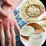 Treatment for Stress-Related Eczema on the Hands