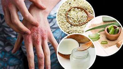 Treatment for Stress-Related Eczema on the Hands